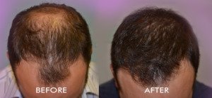 best Hair transplant in pune