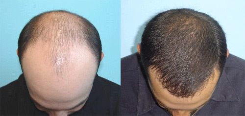 hair-transplant - skin specialist in pune